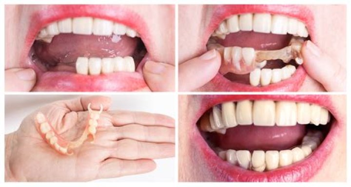 Does Dolly Parton Wear Dentures | False Teeth Before And After