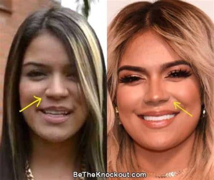 Karol G BBL | Before And After Photos