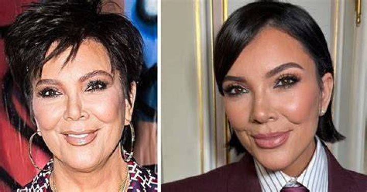 Kris Jenner’s Recent Plastic Surgery: Expert Analysis